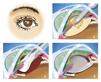 After removing a cataract, scientists used stem cells to regrow the lens. (Image credit: Getty Images via GE Reports)