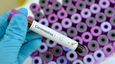 Coronavirus Positive 476433472 4928x3264