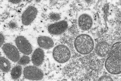 This 2003 electron microscope image made available by the Centers for Disease Control and Prevention shows mature, oval-shaped monkeypox virions, left, and spherical immature virions, right, obtained from a sample of human skin associated with the 2003 prairie dog outbreak. WHO's top monkeypox expert Dr. Rosamund Lewis said she doesn’t expect the hundreds of cases reported to date to turn into another pandemic, but acknowledged there are still many unknowns about the disease, including how exactly it’s spreading and whether the suspension of mass smallpox immunization decades ago may somehow be speeding its transmission.