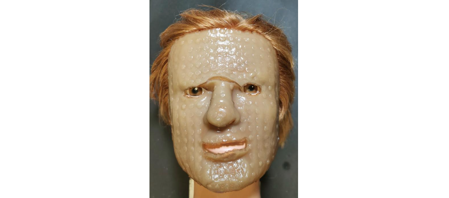 3D-Printed Wound Dressing Could Improve Treatment for Burn, Cancer Patients - Vimarsana News