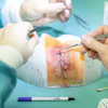 Addion Dap Eyelid Image 2